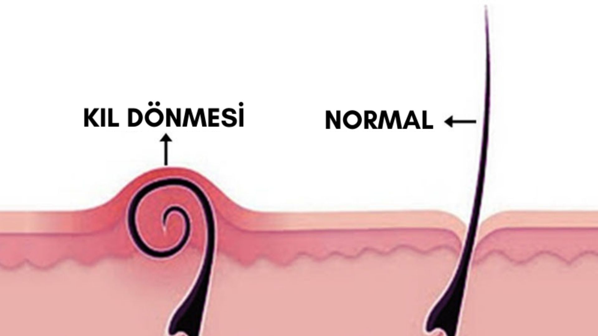 Kil-Donmesinin-Tedavi-Yontemleri